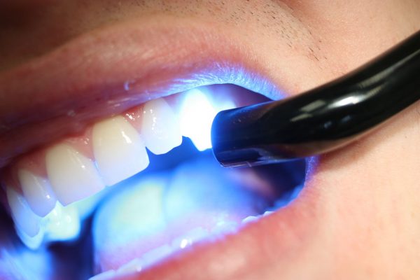 ونیر کامپوزیت و مرحله کیور کردن به وسیله اشعه فرابنفش در درمانگاه دندانپزشکی صدف فردیس