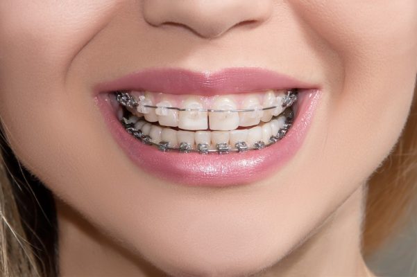 ارتودنسی توسط متخصص ارتودنسی در درمانگاه دندانپزشکی صدف فردیس - متخصص ارتودنسی در فردیس و کرج - درمانگاه دندانپزشکی صدف فردیس ارتودنسی توسط متخصص ارتودنسی در درمانگاه دندانپزشکی صدف فردیس - متخصص ارتودنسی در فردیس و کرج