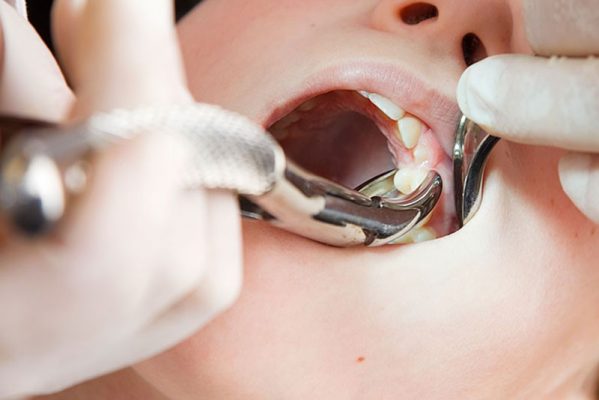 کشیدن دندان، جراحی دندان عقل، کشیدن دندان عقل - کلینیک دندانپزشکی صدف فردیس
