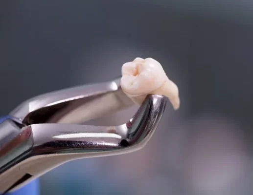 کشیدن دندان، جراحی دندان عقل، کشیدن دندان عقل - کلینیک دندانپزشکی صدف فردیس